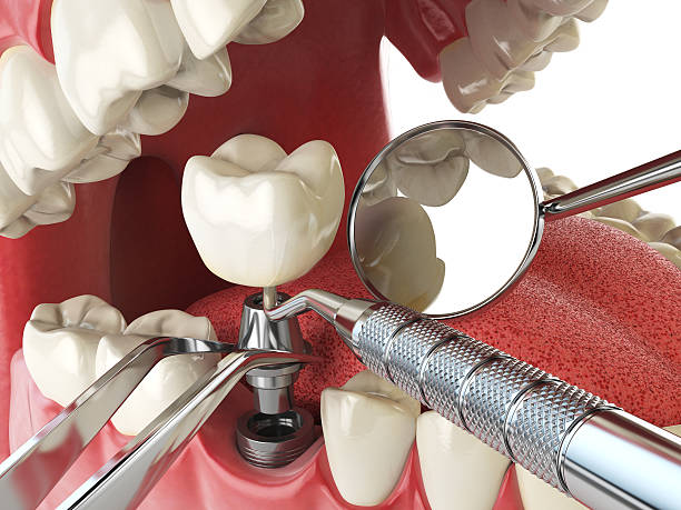 Best Emergency Dental Care for Broken or Chipped Teeth in Baltimore, OH